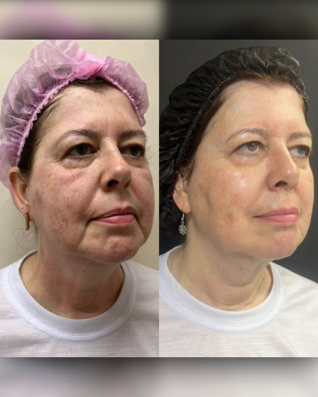 Antes e Depois - Ultrassom Microfocado Face