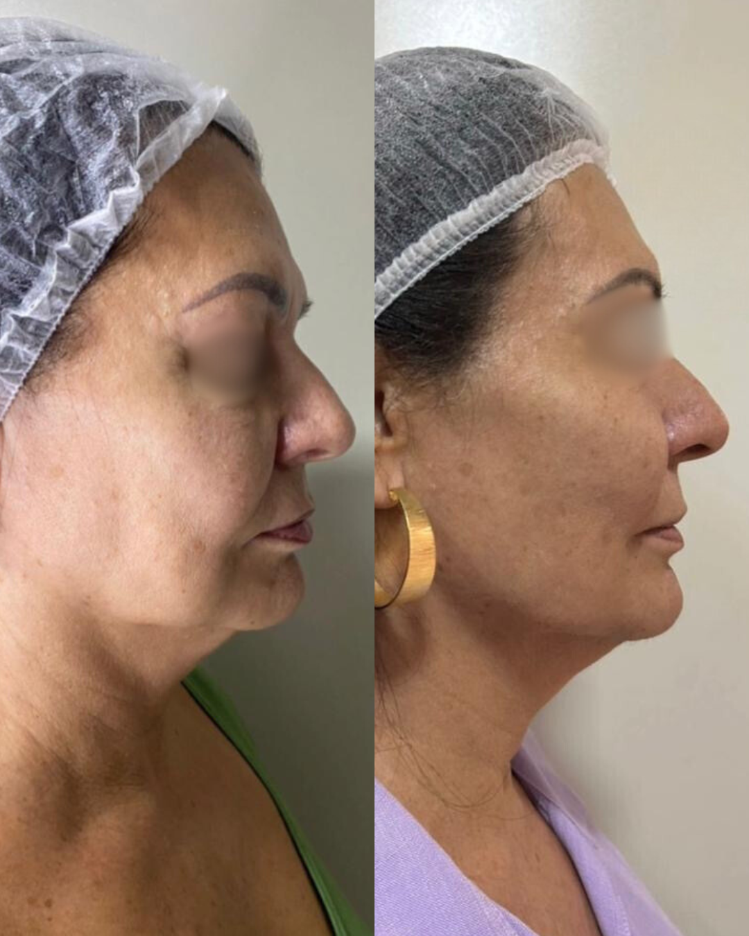 Antes e Depois - Ultrassom Microfocado Perfil